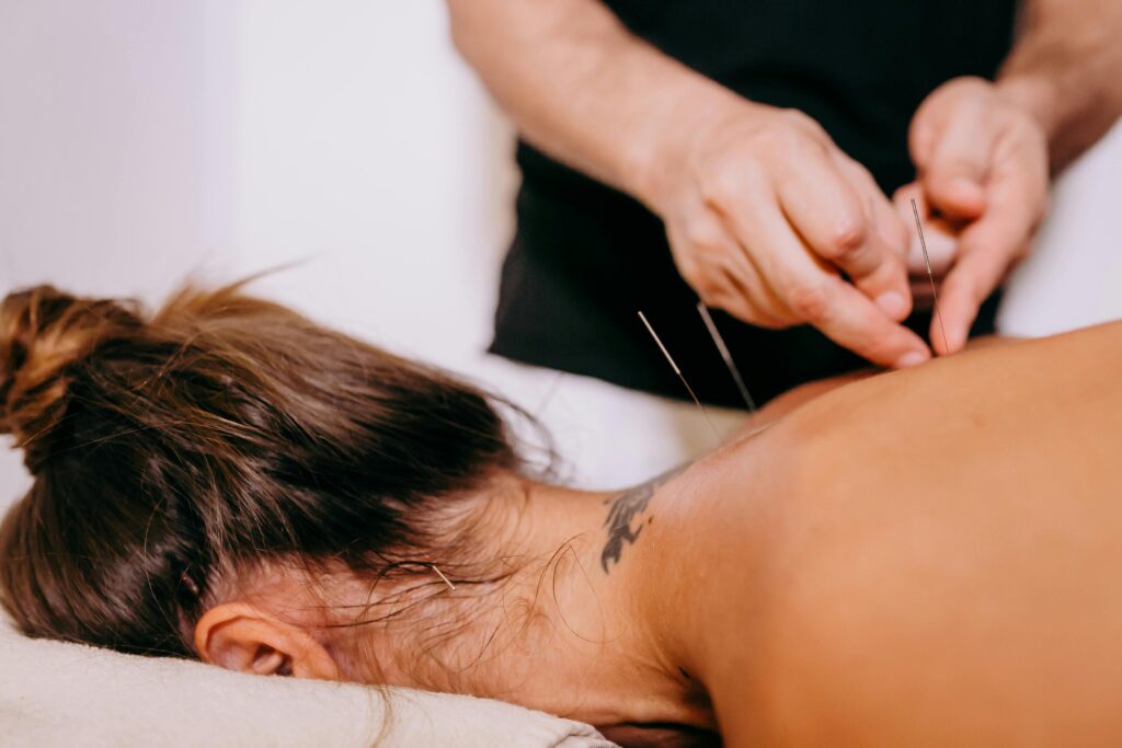Woman receiving Acupuncture